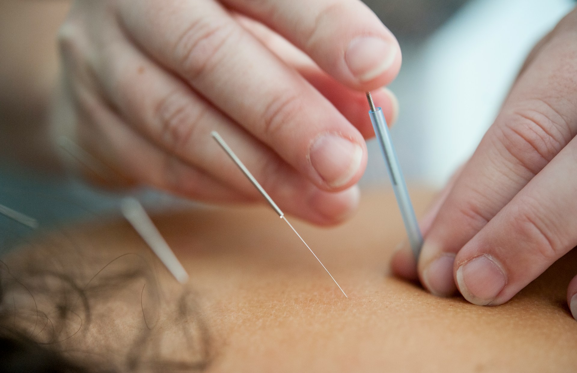 Professional acupuncture treatment at MATCM Student Clinic